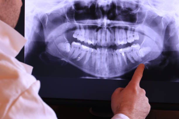 Best Emergency Dentist for Lost Fillings or Crowns in Wantagh, NY