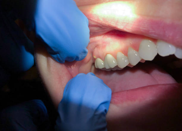 Best Emergency Dentist for Knocked-Out Tooth in Wantagh, NY